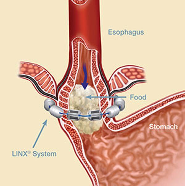 The LINX® System expands temporarily to allow food and liquid to pass into the stomach