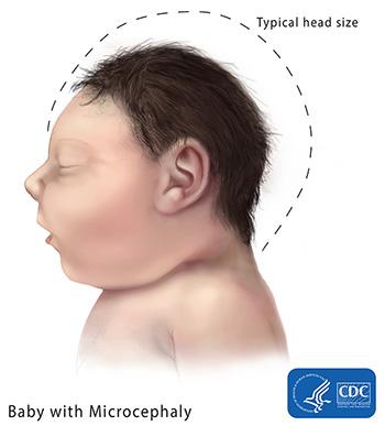 Baby with microcephaly
