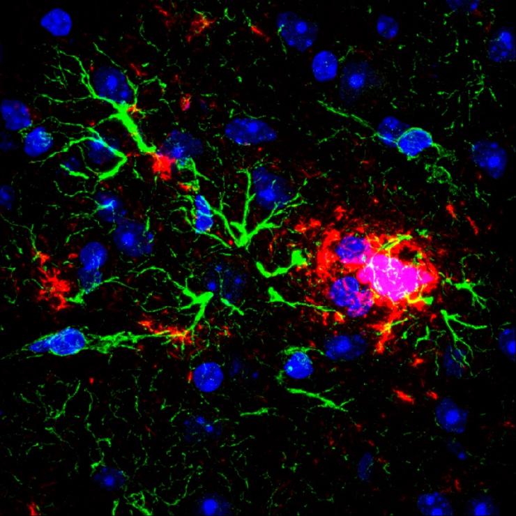 Amyloid plaques(Red) and reactive gliosis(green) visible in staining of APP-knock-in mouse model