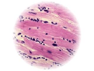 Histological assessment of heart tissue from a patient with myocarditis