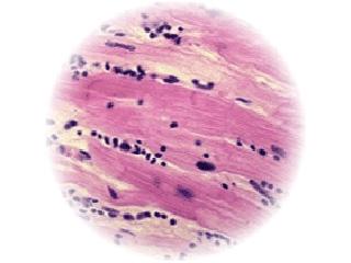 Histological assessment of heart tissue from a patient with myocarditis