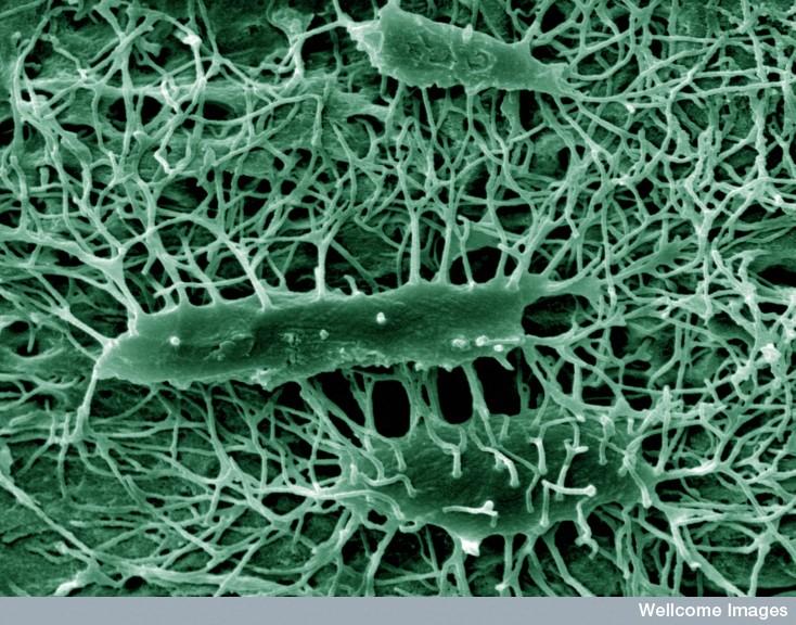 In a WNT1 loss-of-function model, bone mineralization and formation were improved by treatment with an anti-sclerostin antibody, suggesting a potential strategy for treating WNT1-related bone diseases.