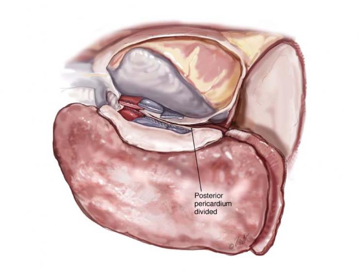 The large vessels and bronchus are dissected and stapled between the heart and the lung. Image courtesy McGraw-Hill Company.