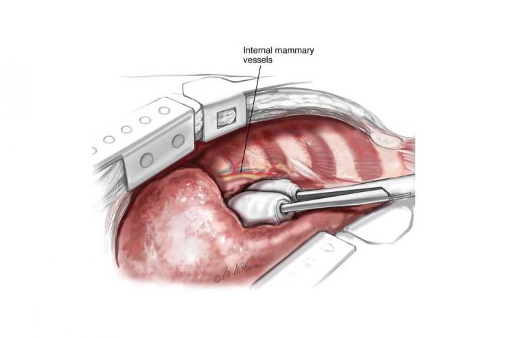 Two chest retractors are placed, one above and one below, to increase the exposure. Image courtesy McGraw-Hill Company.
