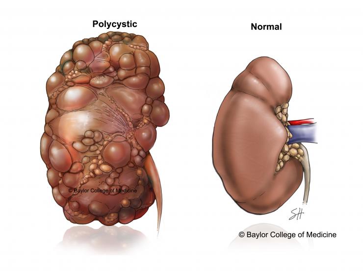 Polycystic compared to normal kidney.
