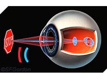 Refractive errors - astigmatism