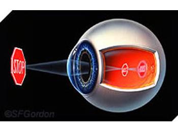 Refractive errors - myopia