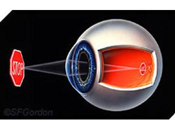 Refractive errors - normal eye