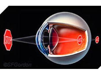 Refractive errors - presbyopia