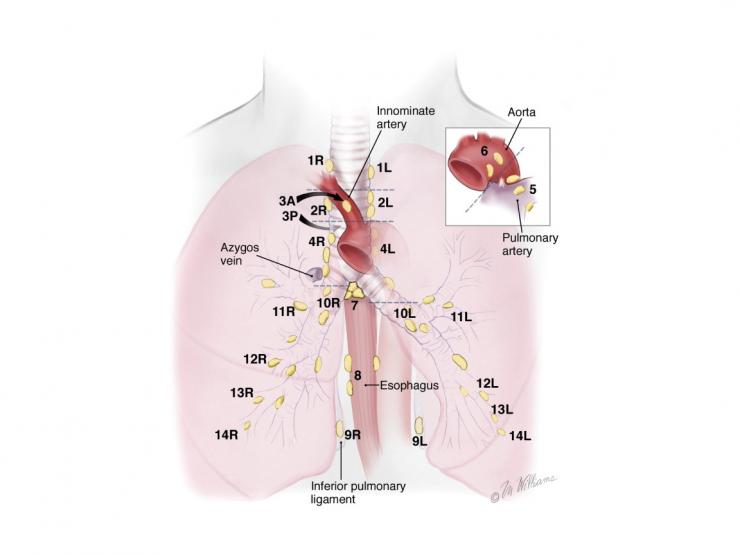 Lung cancer lymph node stations map. Image courtesy McGraw-Hill Company.