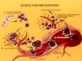 Diagram depicting the steps for metastasis.