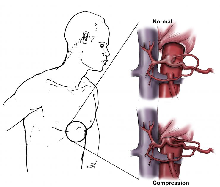 Celiac Artery Compression Syndrome Baylor Medicine