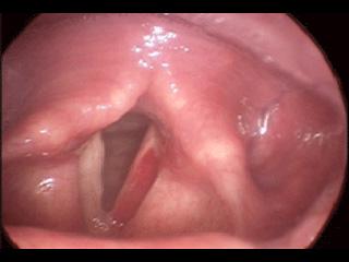 Vocal Fold Hemorrhage