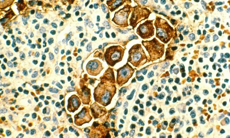 Human metastatic breast cancer cells in lymph nodes. 