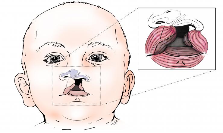 Cleft Palate reconstruction