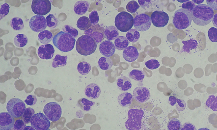 Chronic Myeloid Leukemia Smear
