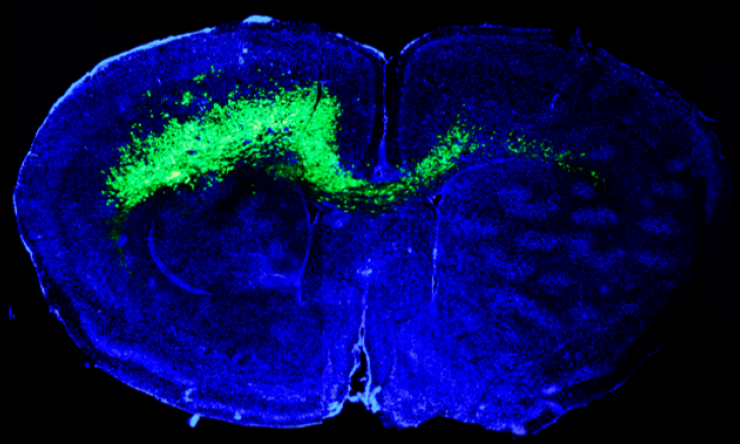 An image of a human brain. The brain is shaded blue with a streak of green passing from the left side to the right to indicate a brain tumor.