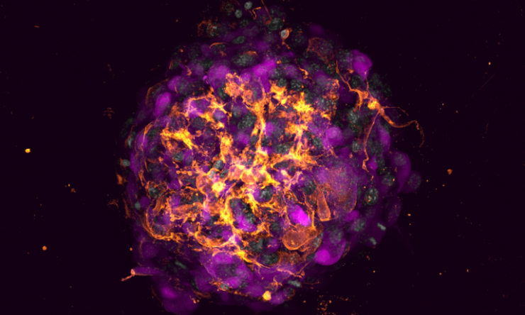 The image this month is a human breast cancer organoid in a collagen-based 3D matrix. The cancer cells (magenta) lack the noncanonical Wnt receptor, Ror2. The protein fibronectin (orange) is up-regulated and assembled by Ror2-deficient tumor cells, triggering the invasion, dissemination and survival of cancer cells during metastatic transit. Nuclei are depicted in gray.