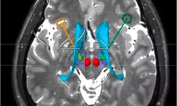 DBS implantation to the STN DBS implantation to the STN