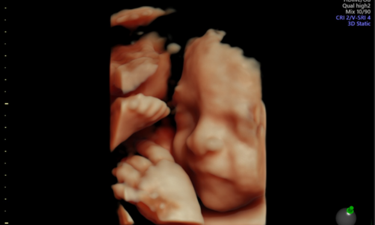 New Ultrasound Image 2023