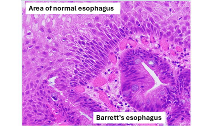 Microscopy view of tissue lining the esophagus showing both normal and Barrett’s esophagus sections. Microscopy view of tissue lining the esophagus showing both normal and Barrett’s esophagus sections.
