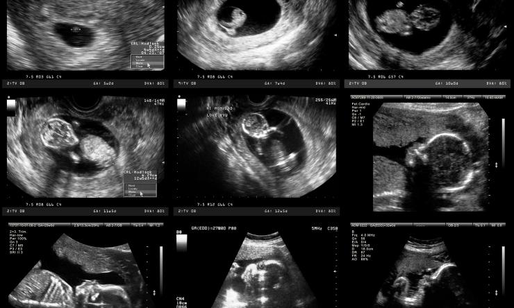Fetal Ultrasound Course