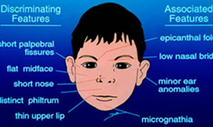 palpebral fissure fetal alcohol syndrome