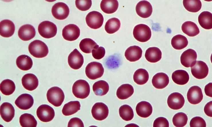 A blood smear sample showcasing giant platelets.