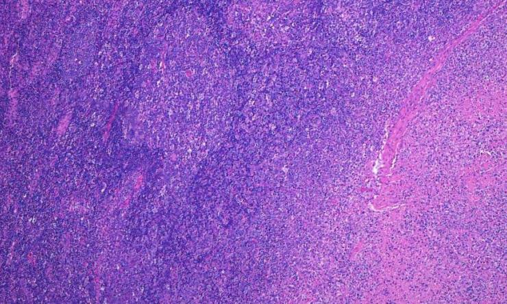 A Lymphnode with Kikuchi disease.