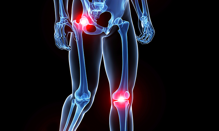 A Recipe For Successful Same-day Hip And Knee Replacements | BCM