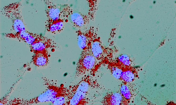 Lipogenesis in Prostate Cancer