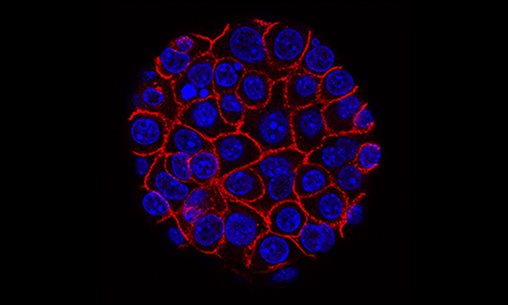 Pancreatic cancer cells (nuclei in blue) growing as a sphere encased in membranes (red). Courtesy of the National Cancer Institute